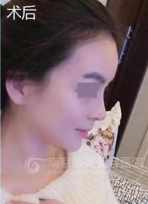 去了南京华美和维多利亚 选择曹海峰鼻综合45天轻松get小翘鼻