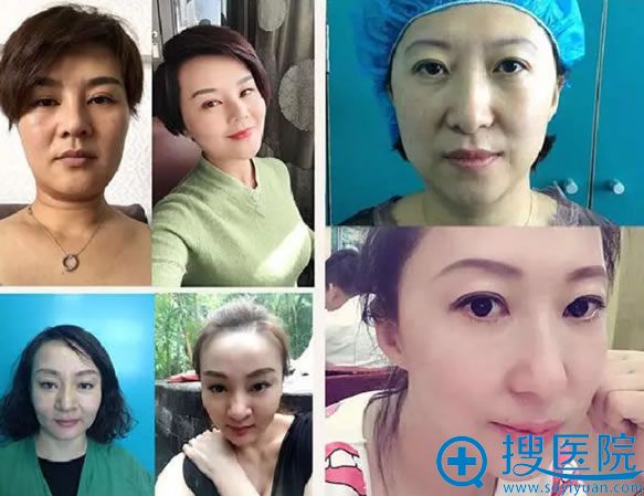 北京丽星面部线雕提升案例 北京丽星面部线雕提升案例
