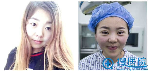 终于在济南韩氏郭广科主任这里圆了我多年的双眼皮梦想