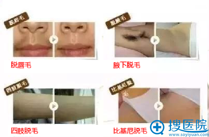 想摆脱毛发困扰 华美紫馨冰点脱毛怎么样?脱毛9.9元起