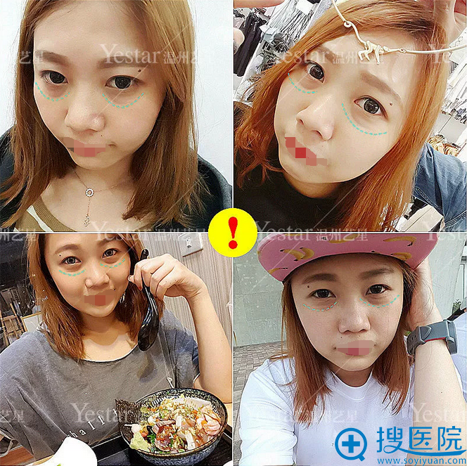 祛眼袋有效的方法是什么?温州艺星手术过程与术后效果分享