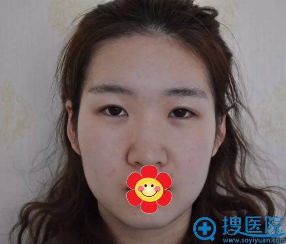在<!--<i data=20240710 data-id=7767></i>-->做面部整形手术前 在<!--<i data=20240710 data-id=7767></i>-->做面部整形手术前