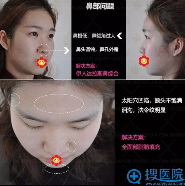 谢惠彬院长设计的鼻部及脂肪填充方案 谢惠彬院长设计的鼻部及脂肪填充方案