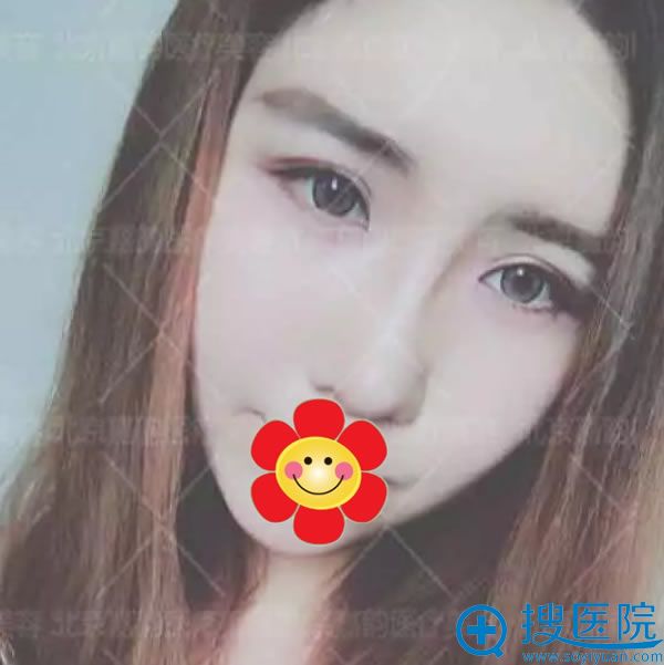 <!--<i data=20240710 data-id=7767></i>-->面部吸脂及轮廓整形案例 <!--<i data=20240710 data-id=7767></i>-->面部吸脂及轮廓整形案例