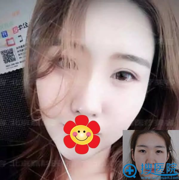 面部吸脂及填充手术50天效果对比图 面部吸脂及填充手术50天效果对比图