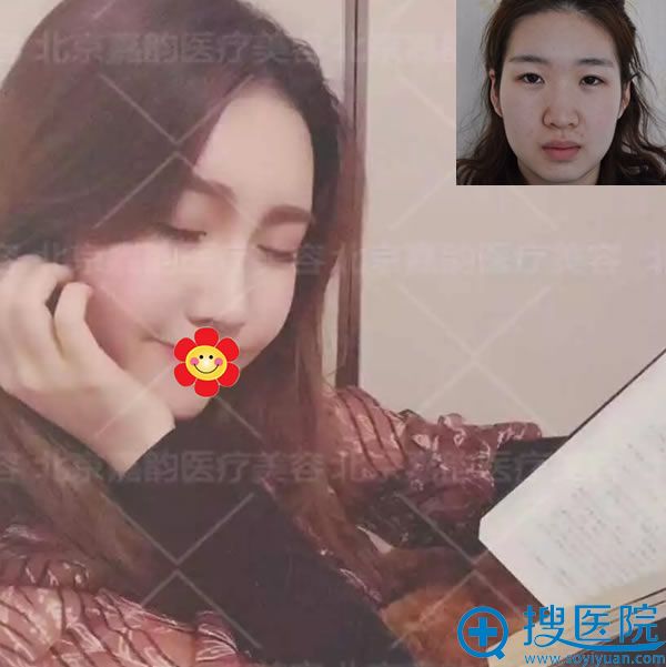 面部吸脂和脂肪填充手术90天效果 面部吸脂和脂肪填充手术90天效果