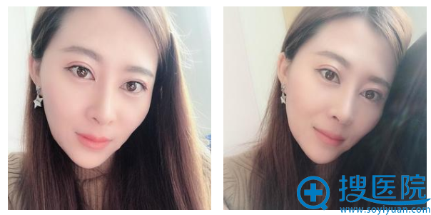 房志强医生做的隆鼻半个月恢复效果 房志强医生做的隆鼻半个月恢复效果
