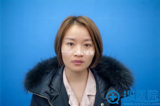 想减龄变美看看苏州美莱肋软骨鼻综合+自体脂肪填充面部案例