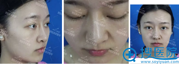 讲述她们隆鼻失败后去贵阳美莱通过达拉斯鼻综合修复成功的经历