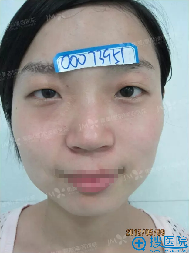 郑州集美整形医院面部轮廓手术真人案例 郑州集美整形医院面部轮廓手术真人案例