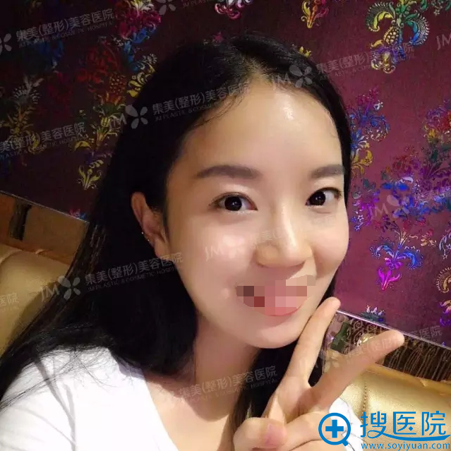 郑州集美整形医院面部轮廓(自体脂肪填充)真人案例 郑州集美整形医院面部轮廓(自体脂肪填充)真人案例
