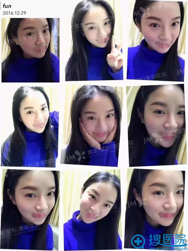 郑州集美自体脂肪面部填充术后恢复效果图 郑州集美自体脂肪面部填充术后恢复效果图