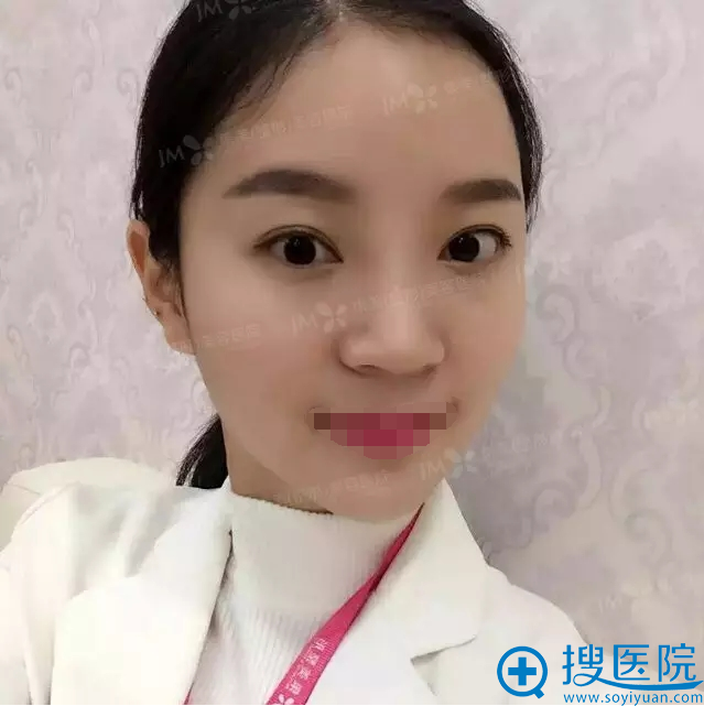 郑州集美整形自体脂肪面部填充+双眼皮恢复图片 郑州集美整形自体脂肪面部填充+双眼皮恢复图片