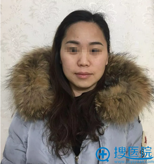 看看石家庄星源美天董宏华脂肪填充面部+颈部术后3个月真实效果