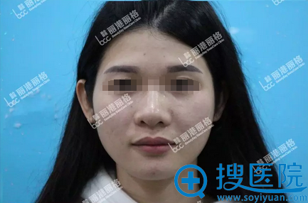 深圳丽港丽格彭静自体脂肪填充全面部 打造精致小V脸
