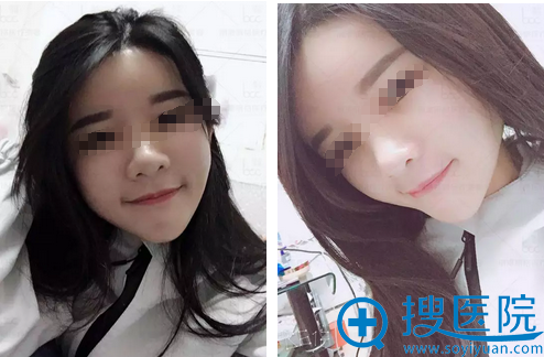 ����ȫ�沿֬���������10��Ч��