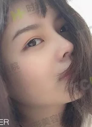 看啊,00后在妈妈陪伴下到重庆时光割双眼皮打造网红芭比眼过程