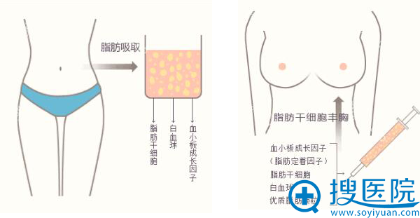假体隆胸和自体隆胸哪个适合我?合肥华美丰胸方式小胸轻松变胸