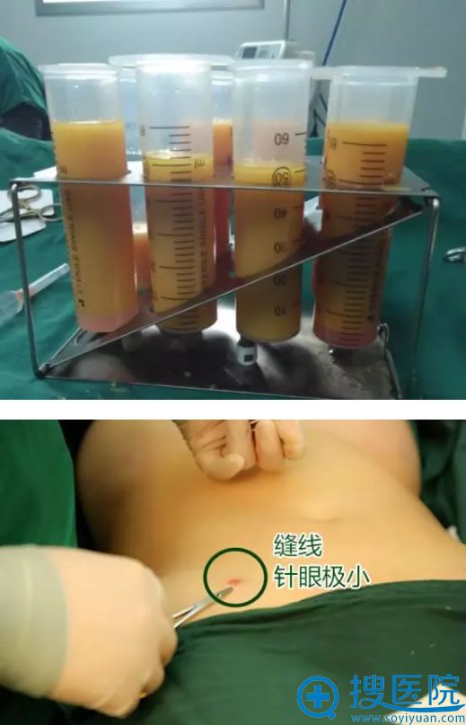 北京焕誉吸脂手术过程图片 北京焕誉吸脂手术过程图片