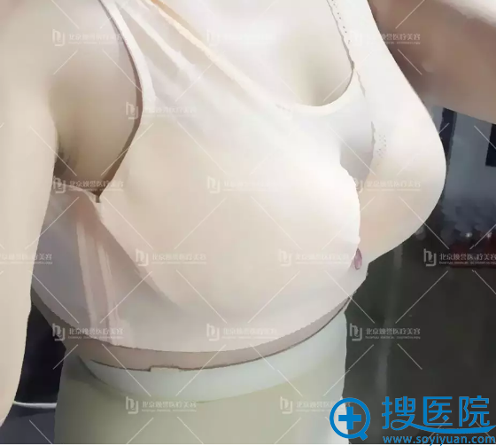 自体脂肪丰胸手术第7天照片 自体脂肪丰胸手术第7天照片