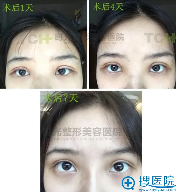 <!--<i data=20240710 data-id=15893></i>-->做双眼皮手术前7天恢复图片 <!--<i data=20240710 data-id=15893></i>-->做双眼皮手术前7天恢复图片