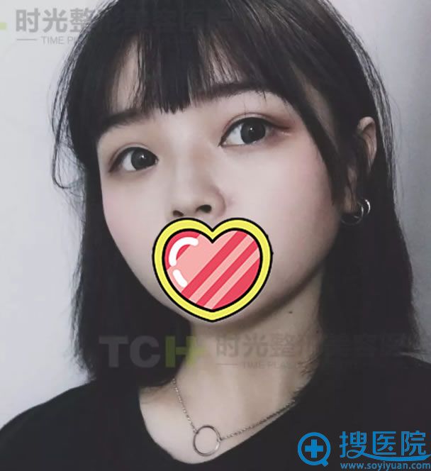 重庆时光双眼皮案例25天效果 重庆时光双眼皮案例25天效果