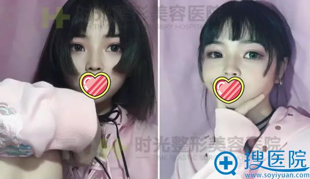 重庆时光双眼皮手术40天效果图 重庆时光双眼皮手术40天效果图