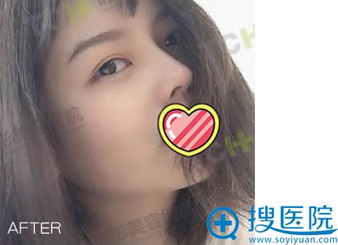 重庆时光注射玻尿酸隆鼻真人案例 重庆时光注射玻尿酸隆鼻真人案例