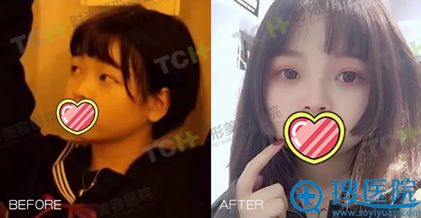 00后做双眼皮和隆鼻手术效果对比图 00后做双眼皮和隆鼻手术效果对比图