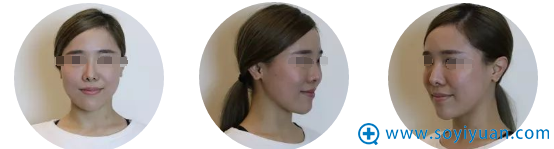 经历2次隆鼻失败,第三次在遵义韩美找回属于自己的美丽