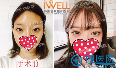 韩国iwell爱我整形美容医院自然粘连双眼皮术后效果,你羡慕吗
