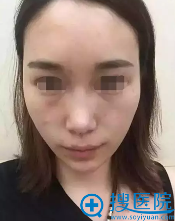 郑州芳艺整形曾康线雕提拉脸颊苹果肌+线雕隆鼻术后效果展示
