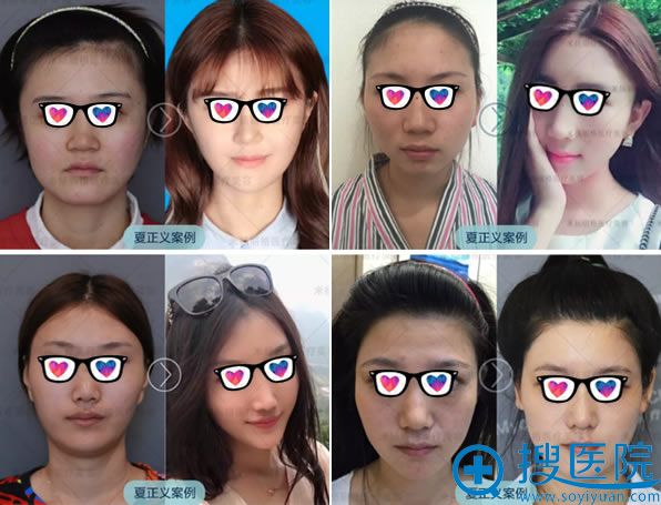北京米扬丽格夏正义自体脂肪填充案例 北京米扬丽格夏正义自体脂肪填充案例