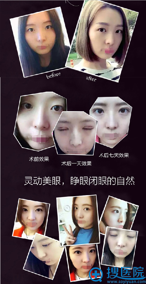 术前术后效果对比 术前术后效果对比