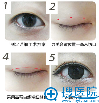 睛彩美瞳术手术过程 睛彩美瞳术手术过程