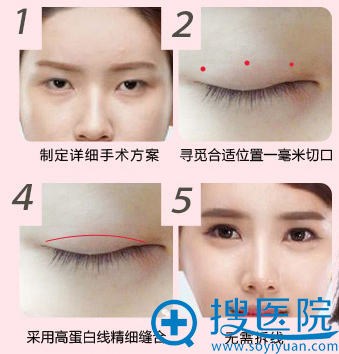 1+N双太定制美眼术 1+N双太定制美眼术