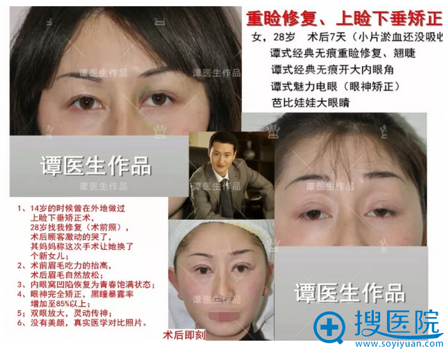 重睑修复、上睑下垂矫正 重睑修复、上睑下垂矫正