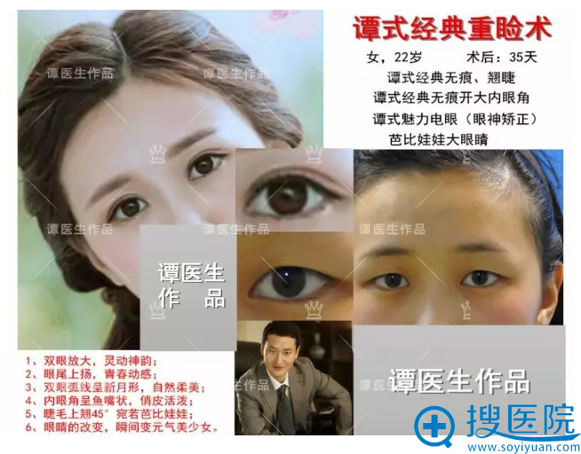 开大内眼角+无痕双眼皮 开大内眼角+无痕双眼皮