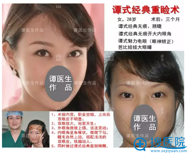 谭式经典重睑术 谭式经典重睑术