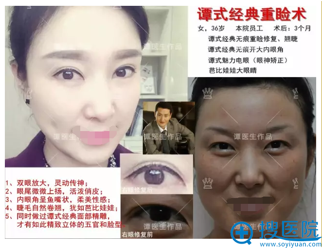 双眼皮+开眼角+面部精雕 双眼皮+开眼角+面部精雕