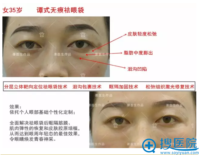 脂肪轻度膨出 术前术后 脂肪轻度膨出 术前术后