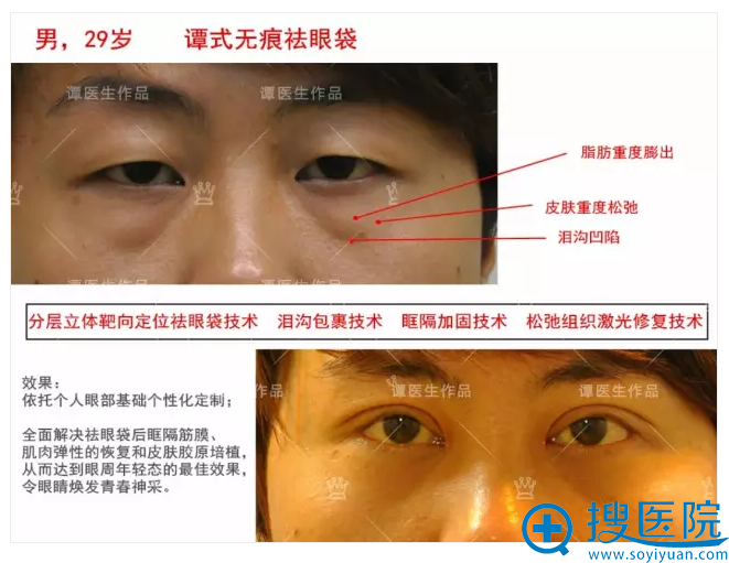 脂肪重度膨出 祛眼袋+双眼皮 脂肪重度膨出 祛眼袋+双眼皮