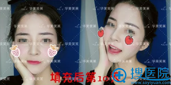 注射玻尿酸丰下巴术后10天效果 注射玻尿酸丰下巴术后10天效果