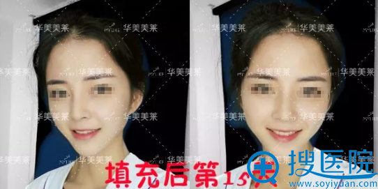 <!--<i data=20240710 data-id=5560></i>-->玻尿酸填充面部术后15天效果 <!--<i data=20240710 data-id=5560></i>-->玻尿酸填充面部术后15天效果
