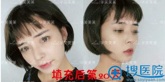 玻尿酸隆鼻丰下巴术后20天恢复照 玻尿酸隆鼻丰下巴术后20天恢复照
