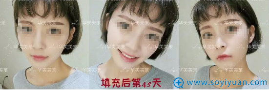 <!--<i data=20240710 data-id=5560></i>-->玻尿酸隆鼻丰下巴45天 <!--<i data=20240710 data-id=5560></i>-->玻尿酸隆鼻丰下巴45天