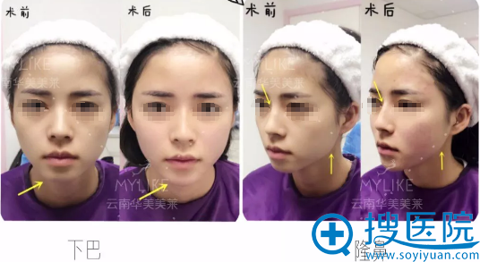 玻尿酸隆鼻丰下巴术后对比照 玻尿酸隆鼻丰下巴术后对比照