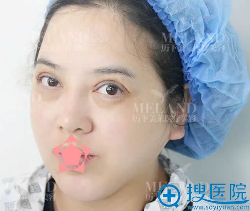 做完修复手术后即刻的样子 做完修复手术后即刻的样子
