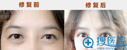 <!--<i data=20240710 data-id=14184></i>-->韩旭双眼皮修复后1个月对比照 <!--<i data=20240710 data-id=14184></i>-->韩旭双眼皮修复后1个月对比照