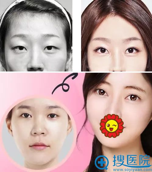 南充韩美双眼皮手术案例 南充韩美双眼皮手术案例